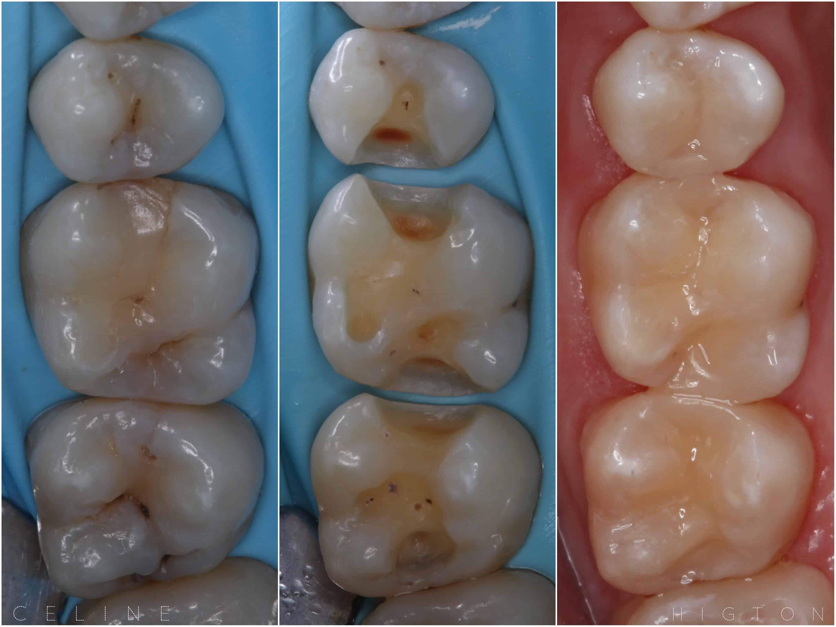 Tooth Filling By Dr Celine Higton At Beverley Dental Raynes Park London
