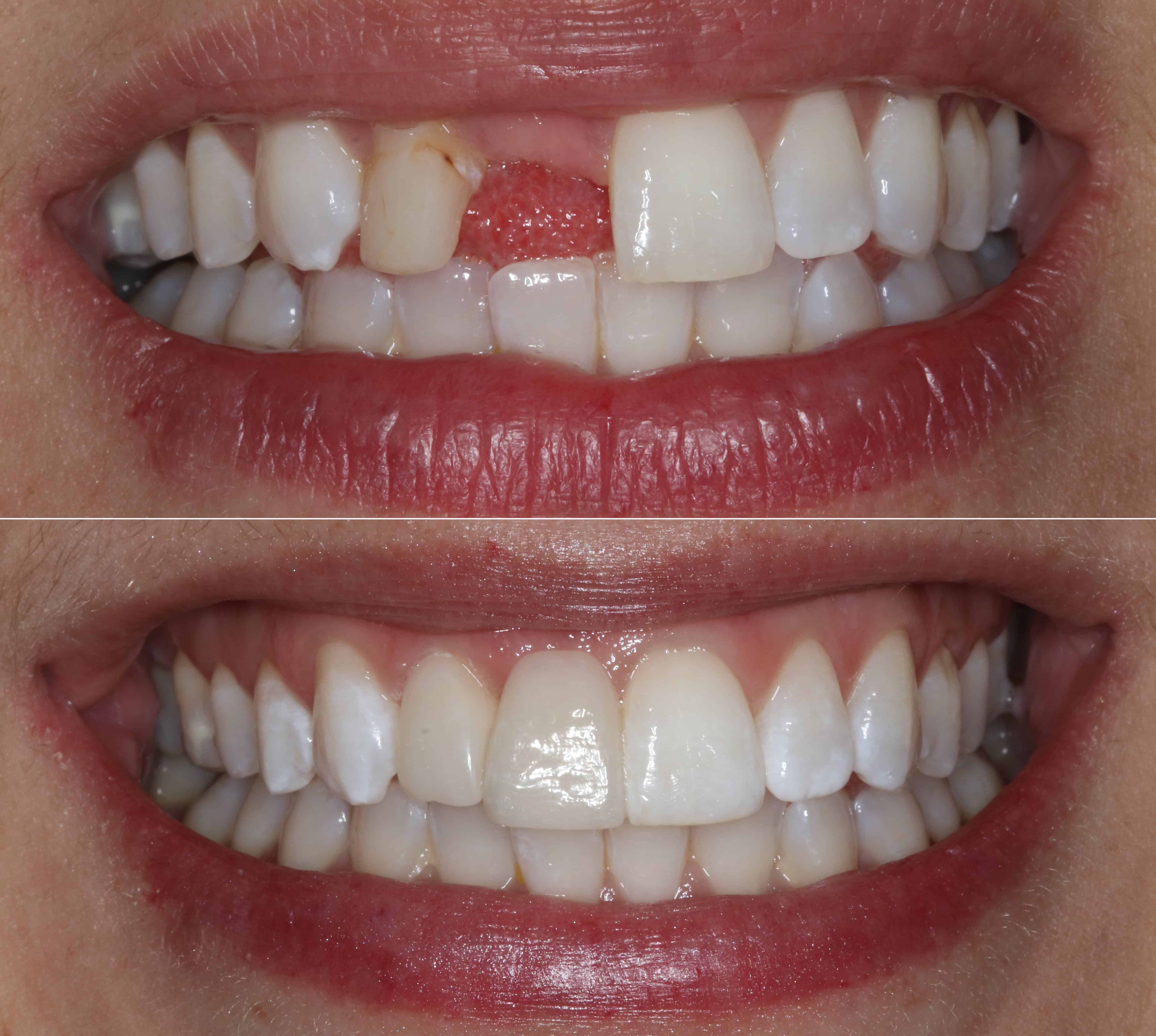 Adhesive Bridge By Dr Celine Higton At Beverley Dental Raynes Park London