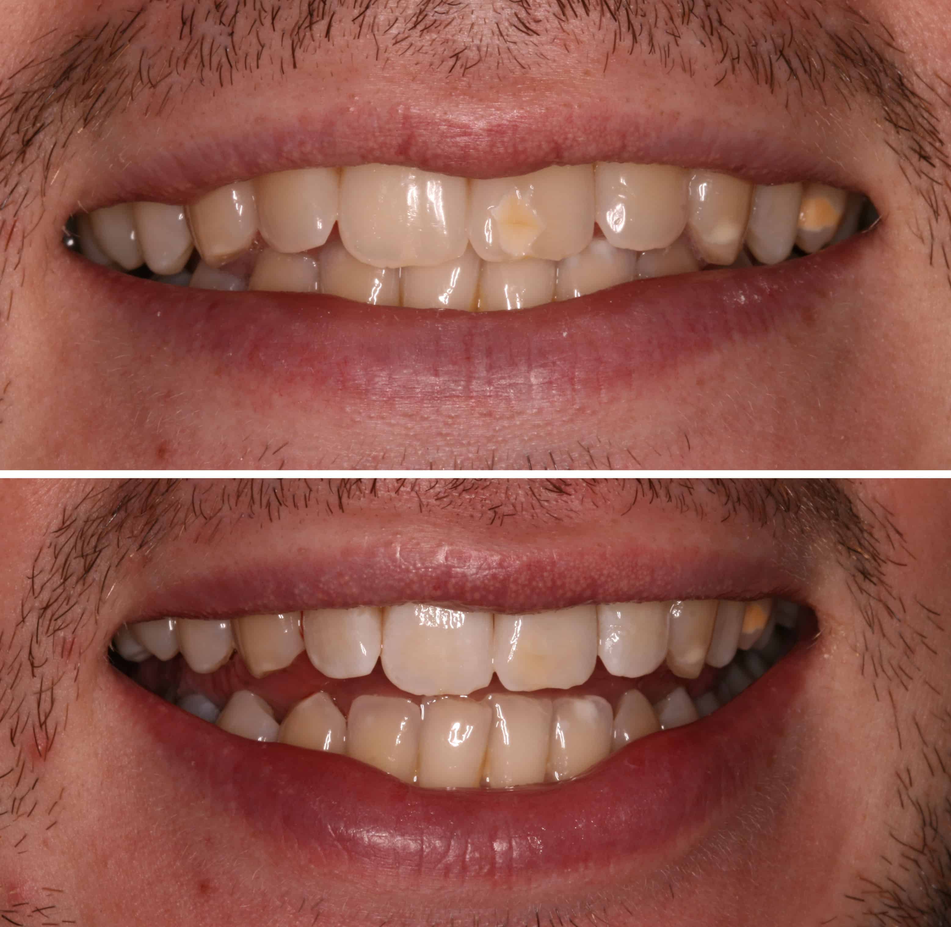 ICON Treatment By Dr Ben Walker At Beverley Dental Raynes Park London