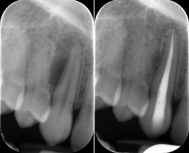 Root Canal Treatment Xray By Dr Celine Higton At Beverley Dental Raynes Park London