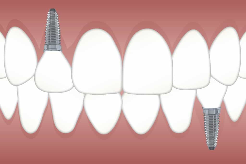 What are dental implants?