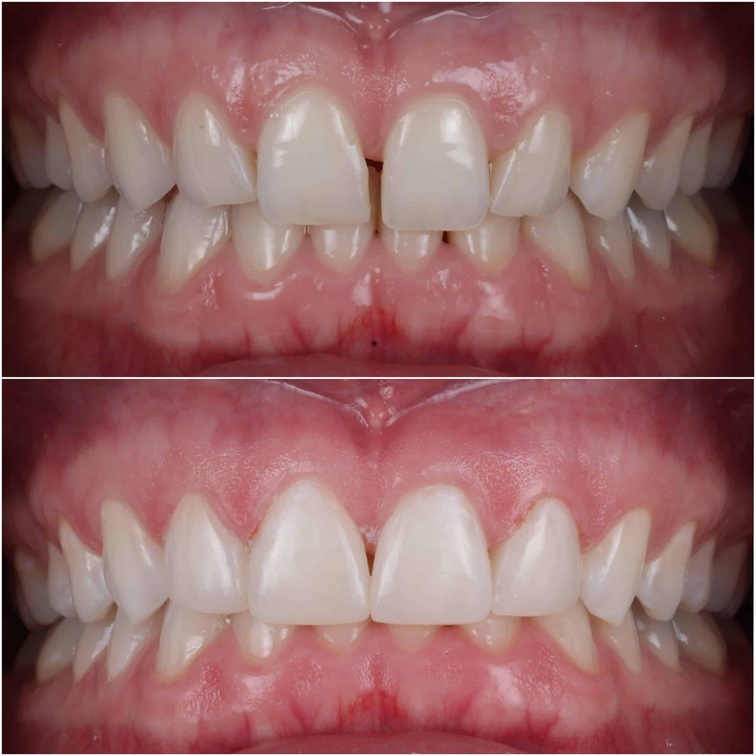 Composite Bonding Raynes Park - A Patient Showcases Their Dental Transformation Through Composite Bonding At Beverley Dental In Raynes Park. The Image Presents A Before-and-after Comparison Of The Patient's Teeth. In The 