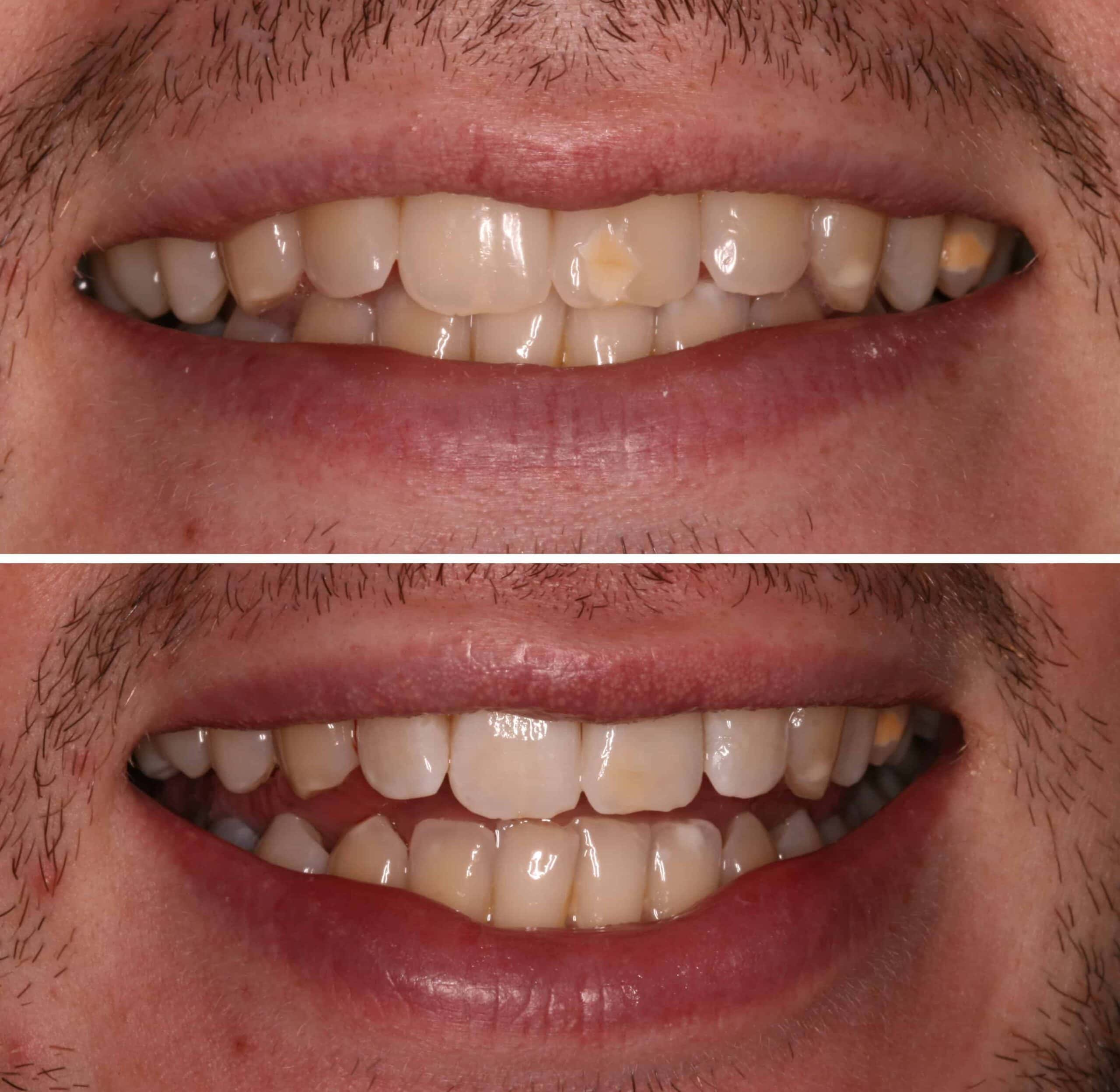 Icon Treatment Raynes Park - The Image Showcases A Before-and-after Comparison Of A Dental Treatment At Beverley Dental In Raynes Park. The Top Half Of The Image Displays The Patient's Smile Before The Treatment, Highlighting Discolored And Uneven Teeth. The Bottom Half Reveals The Results After The Dental Procedure, Showing A Significantly Improved Smile With Whiter And More Even Teeth. This Transformation Illustrates The Effectiveness Of The Icon Treatment Provided By Beverley Dental, Emphasizing Their Expertise In Cosmetic Dentistry And Commitment To Enhancing Patients' Smiles Through Advanced Techniques.